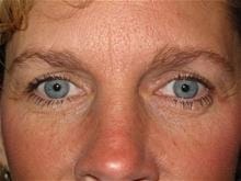 A result from Kramer Plastic Surgery