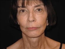 A result from Kramer Plastic Surgery