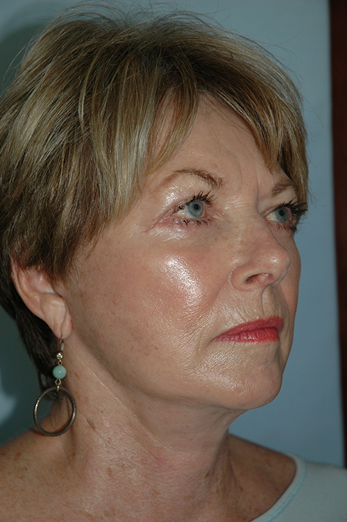 Facelift result at Gardner Facial Plastic Surgery