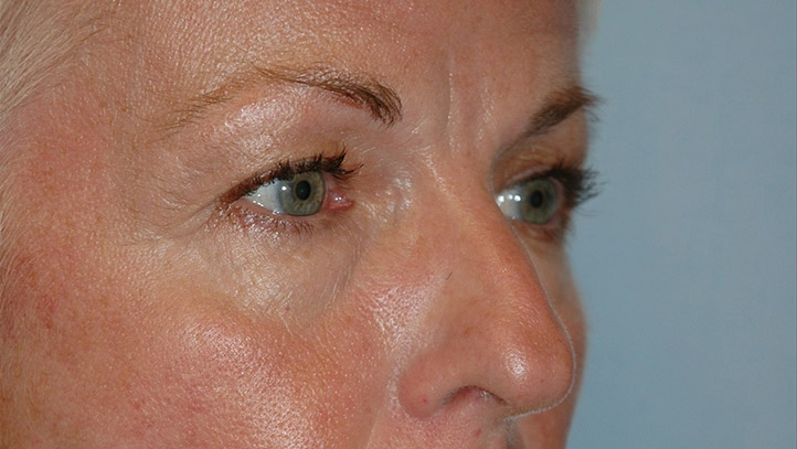 Blepharoplasty before photo