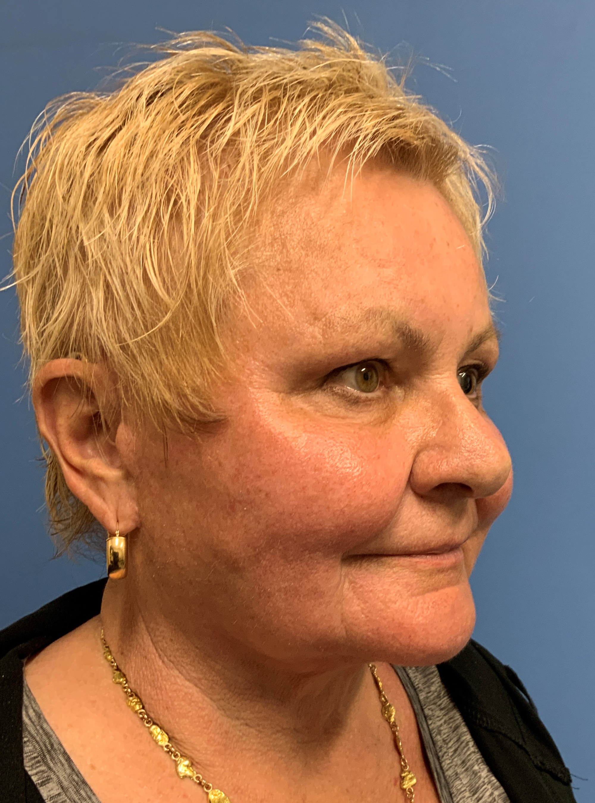 A result from Gardner Facial Plastic Surgery