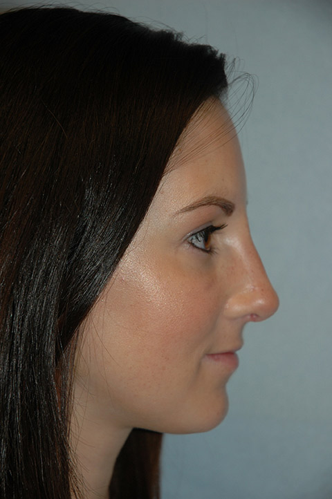 A result from Gardner Facial Plastic Surgery
