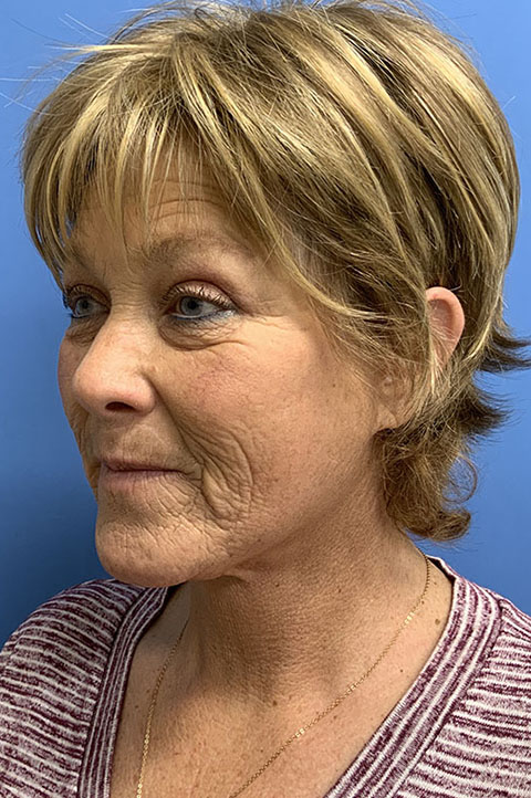 Facelift result at Gardner Facial Plastic Surgery