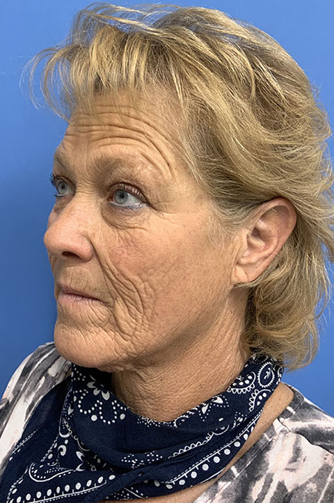 Facelift before photo