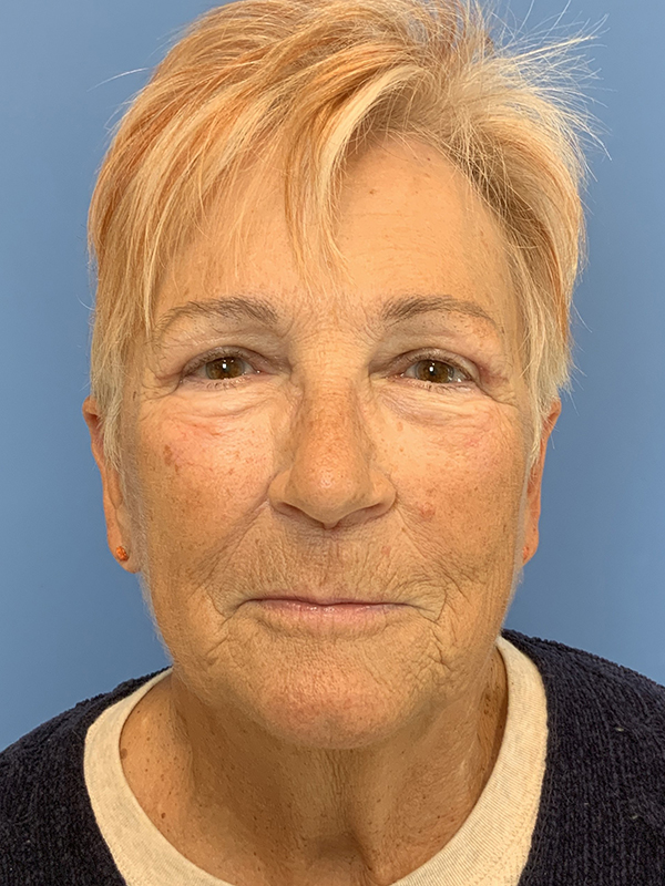 Gardner Facial Plastic Surgery blepharoplasty after — St. George, UT