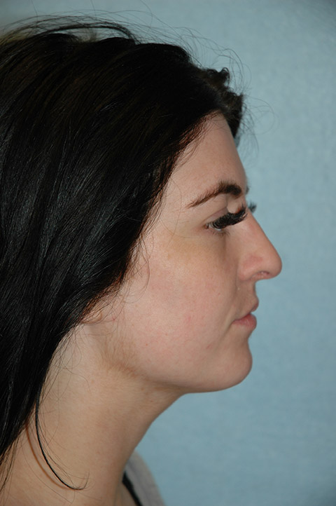 Gardner Facial Plastic Surgery rhinoplasty after — St. George, UT