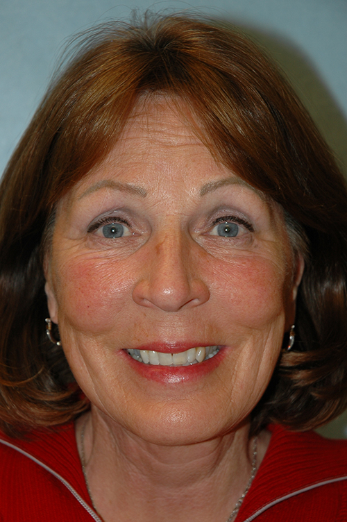 Facelift result at Gardner Facial Plastic Surgery