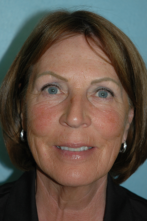 Facelift before photo