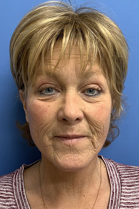 Facelift result at Gardner Facial Plastic Surgery