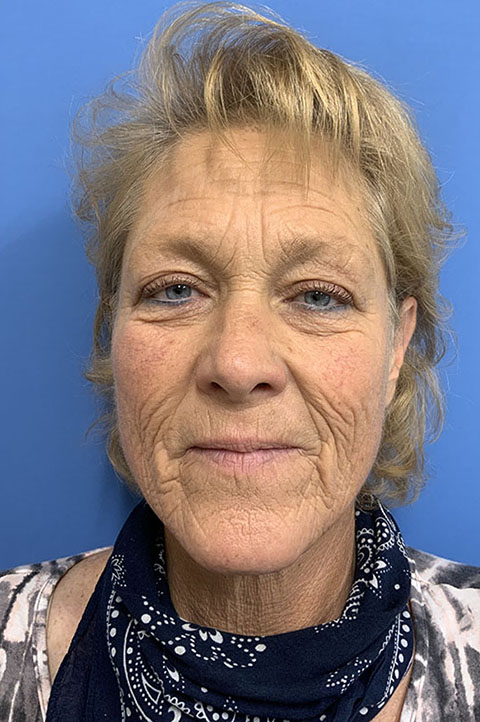 Facelift before photo