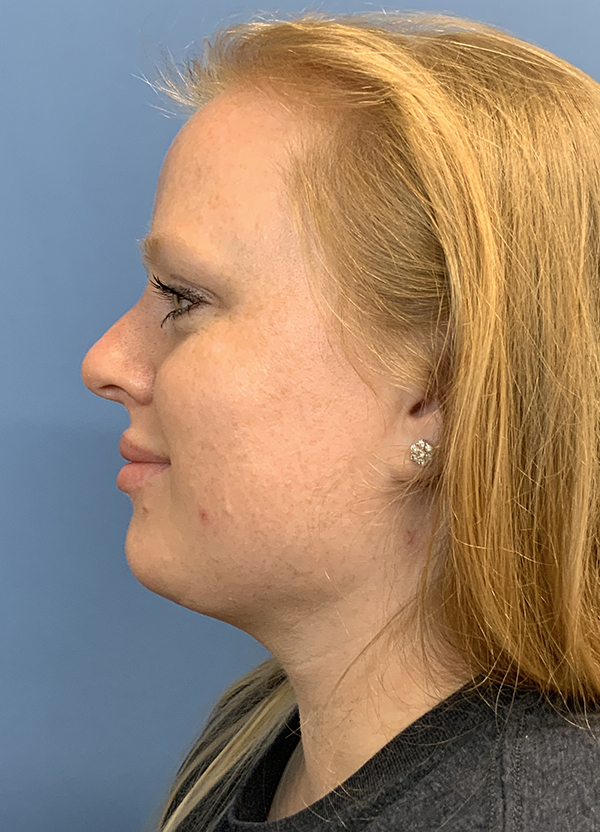 Gardner Facial Plastic Surgery neck lift after — St. George, UT
