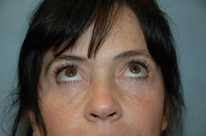 Blepharoplasty result at Gardner Facial Plastic Surgery