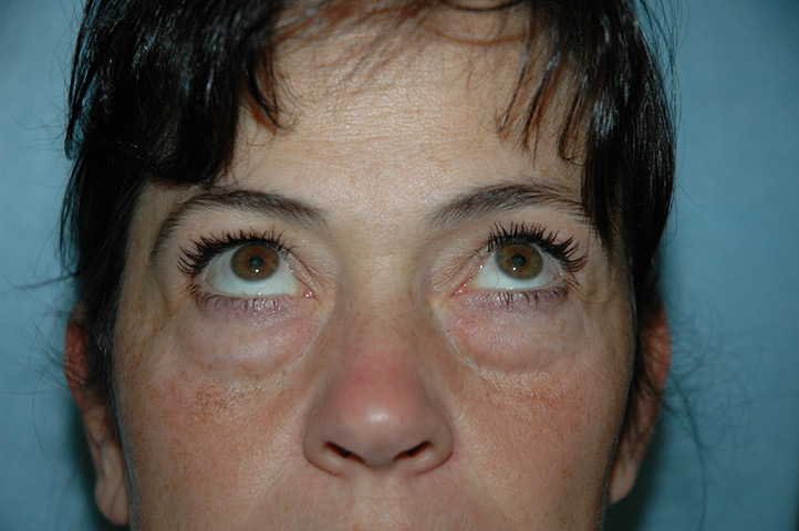 Blepharoplasty before photo