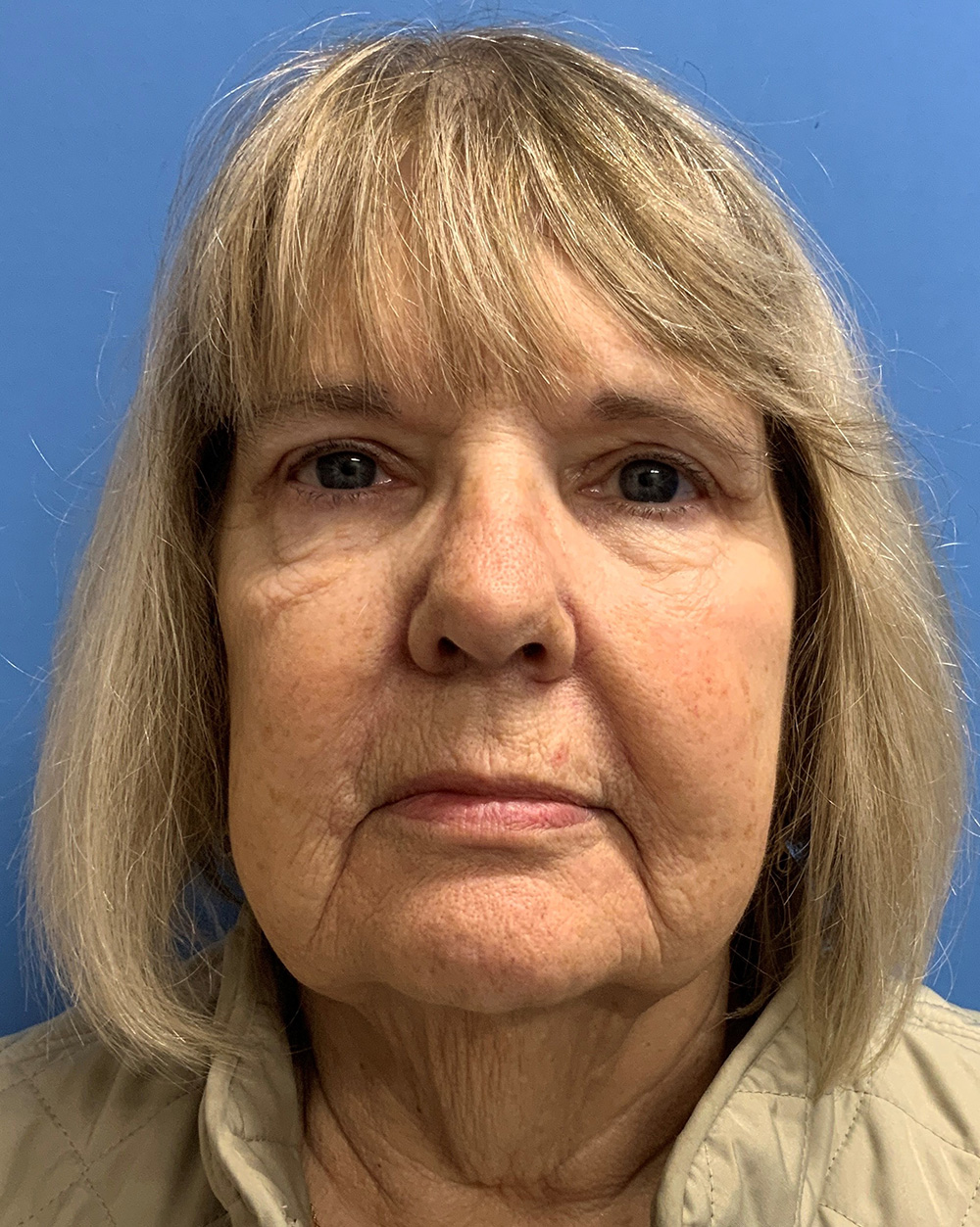 Blepharoplasty result at Gardner Facial Plastic Surgery