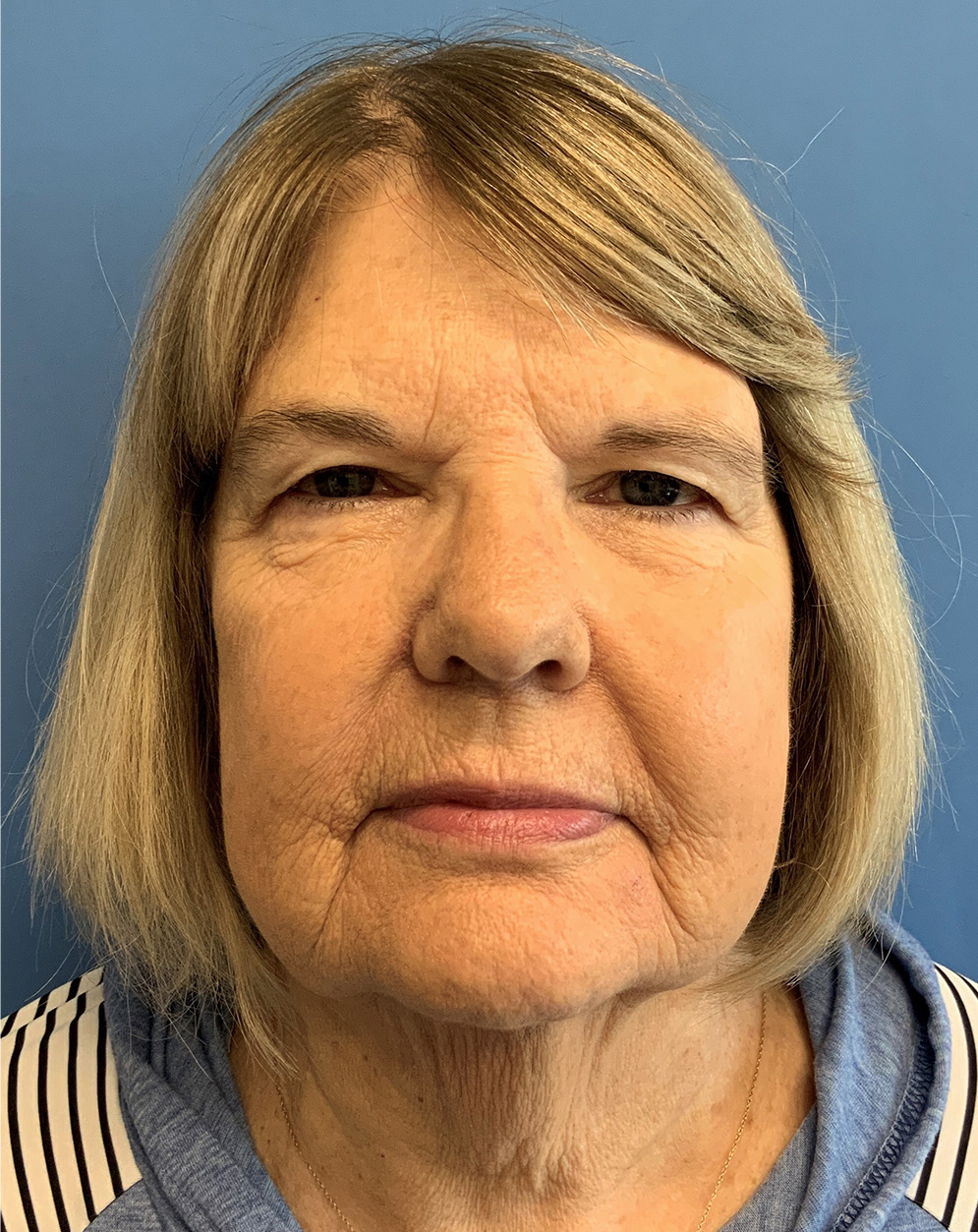 Blepharoplasty before photo