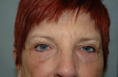 Blepharoplasty result at Gardner Facial Plastic Surgery