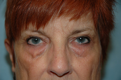 Blepharoplasty before photo