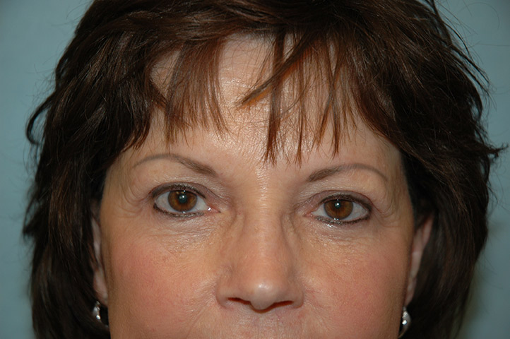 Blepharoplasty result at Gardner Facial Plastic Surgery