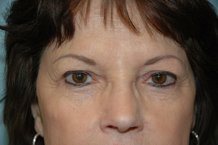 Blepharoplasty before photo