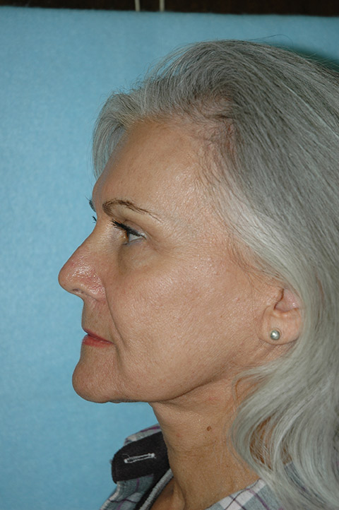 Facelift result at Gardner Facial Plastic Surgery