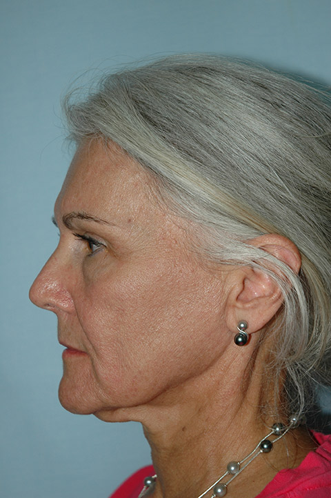Facelift before photo