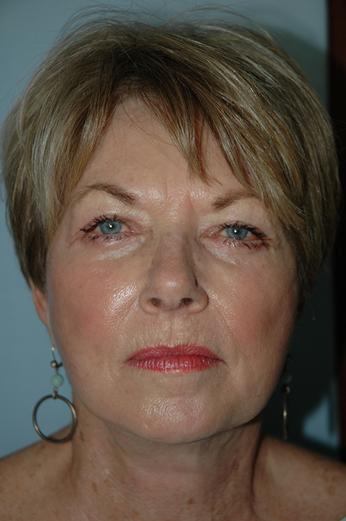 Facelift result at Gardner Facial Plastic Surgery