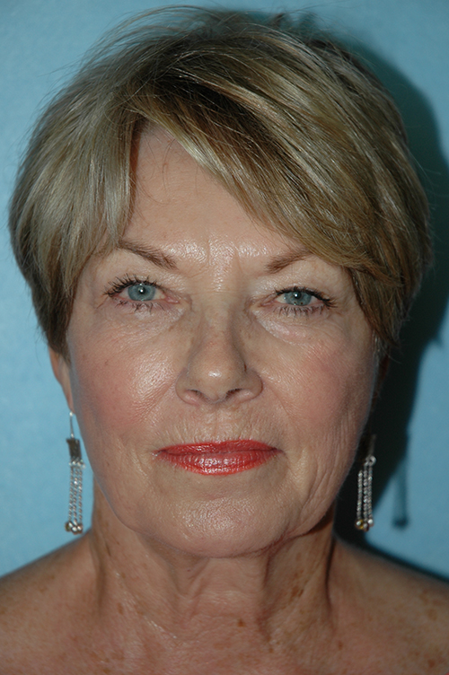 Facelift before photo