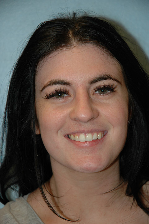 Gardner Facial Plastic Surgery rhinoplasty after — St. George, UT