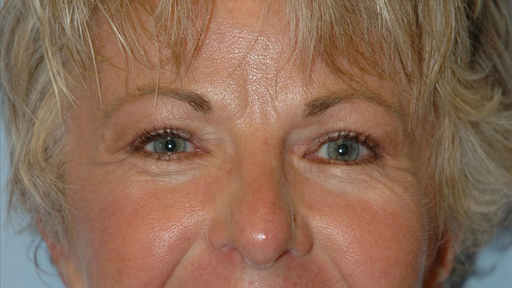 Blepharoplasty result at Gardner Facial Plastic Surgery
