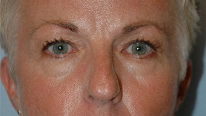 Blepharoplasty before photo