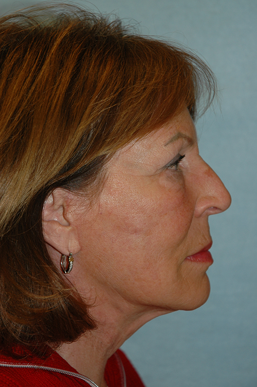 Facelift result at Gardner Facial Plastic Surgery