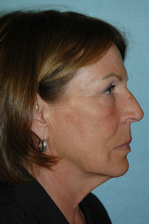 Facelift before photo
