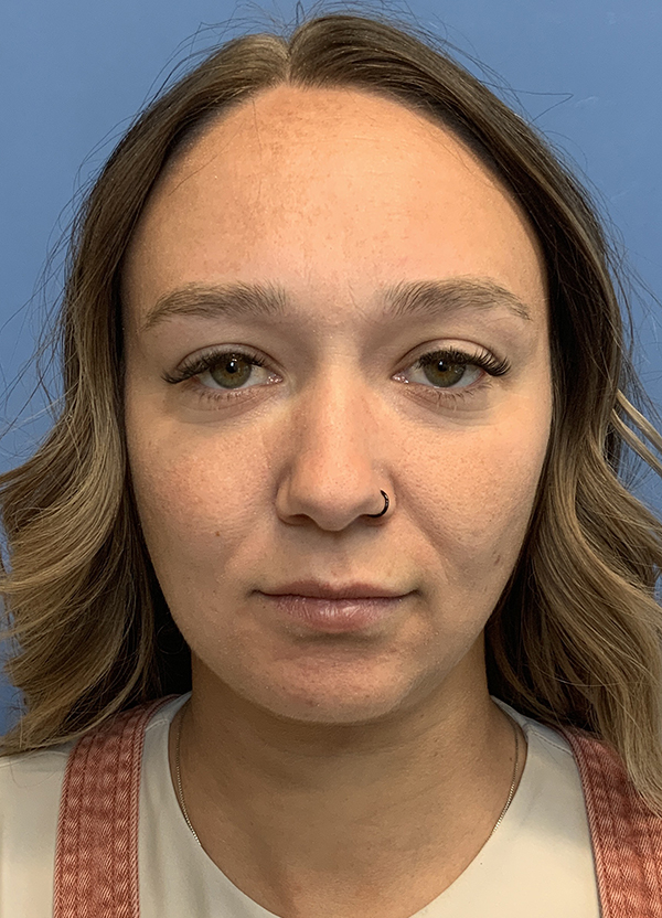 Gardner Facial Plastic Surgery neck lift after — St. George, UT