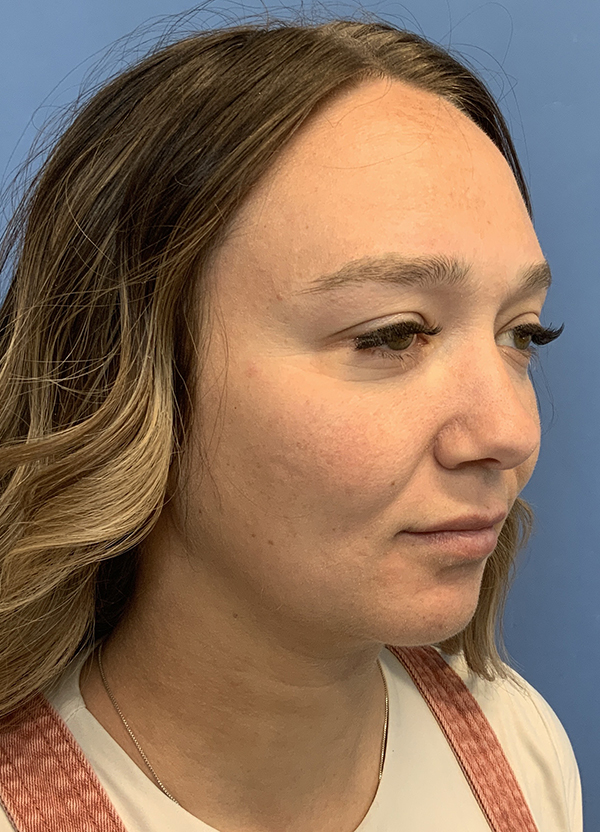 Gardner Facial Plastic Surgery neck lift after — St. George, UT