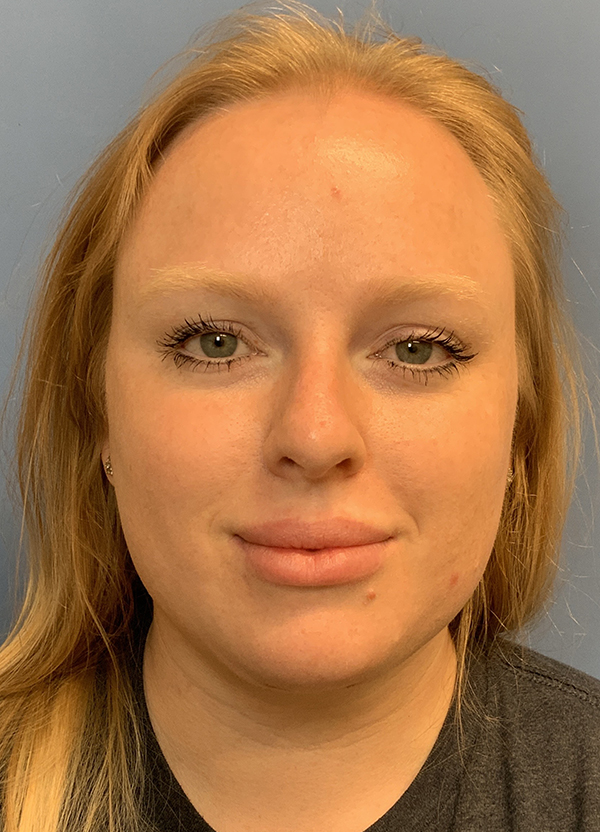 Gardner Facial Plastic Surgery neck lift after — St. George, UT