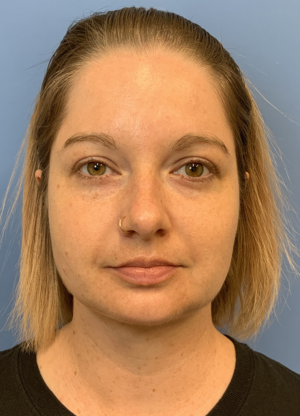 Gardner Facial Plastic Surgery neck lift after — St. George, UT