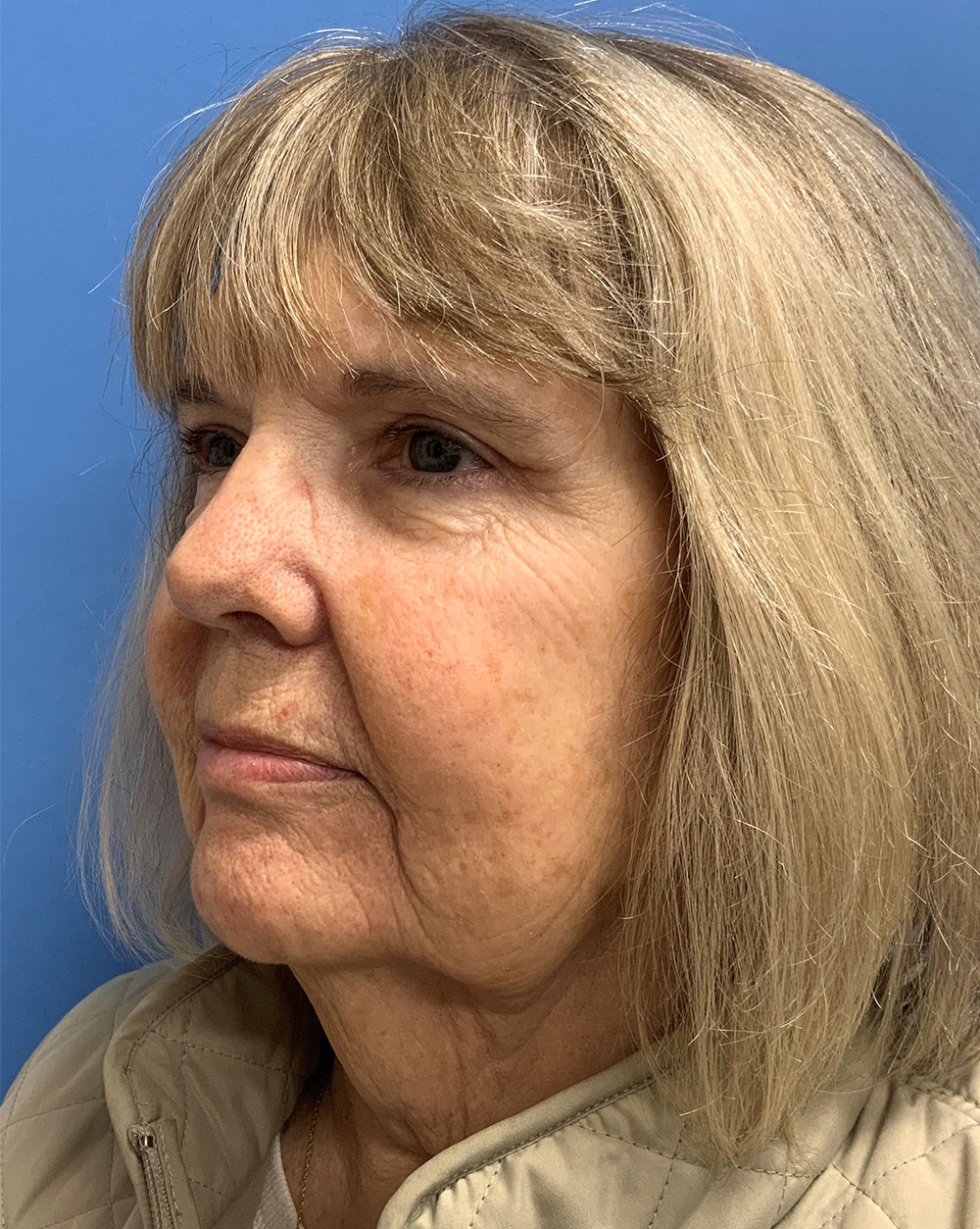 Blepharoplasty result at Gardner Facial Plastic Surgery