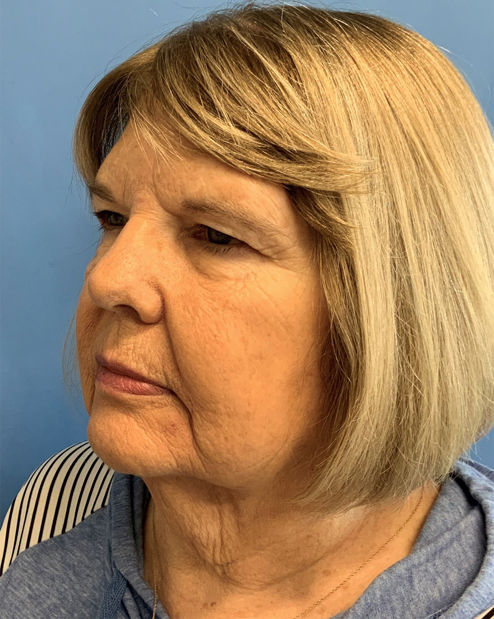 Blepharoplasty before photo