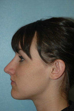 Otoplasty result at Gardner Facial Plastic Surgery