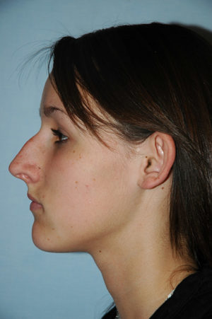 Otoplasty before photo