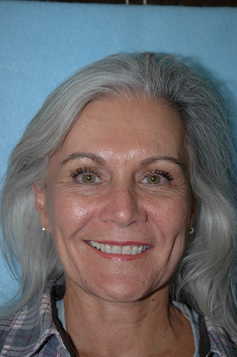 Facelift result at Gardner Facial Plastic Surgery