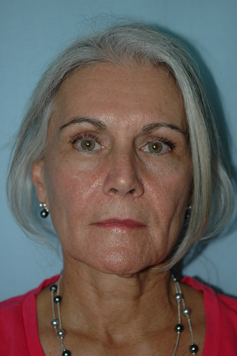 Facelift before photo
