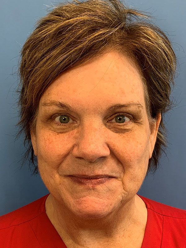 Blepharoplasty result at Gardner Facial Plastic Surgery