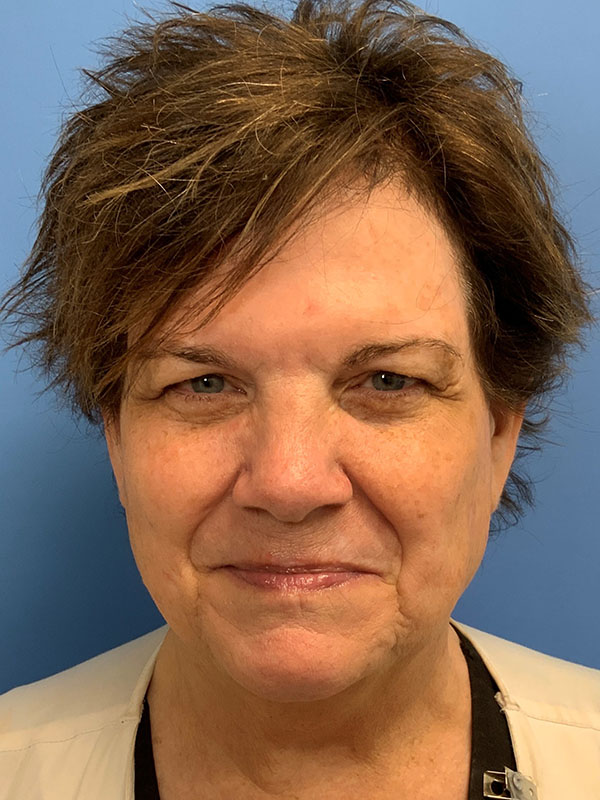Blepharoplasty before photo