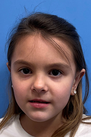Otoplasty result at Gardner Facial Plastic Surgery