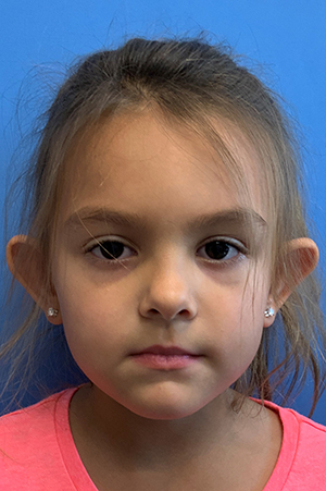 Otoplasty before photo