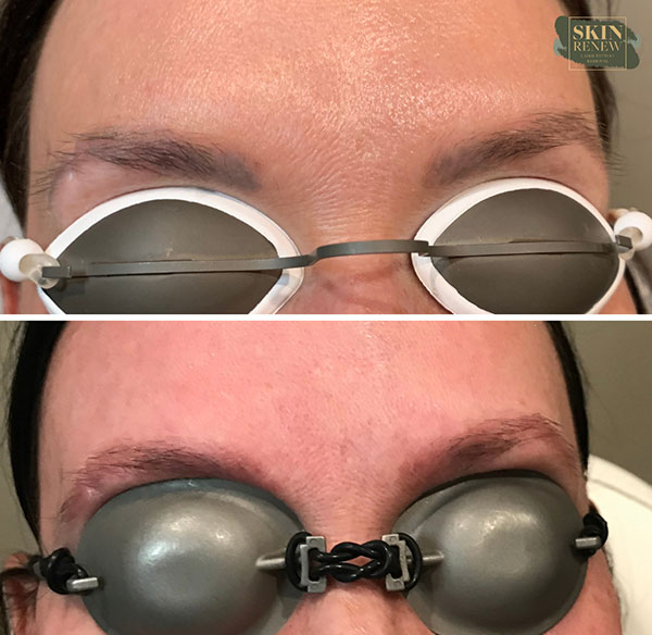 A result from Skin Renew Day Spa & Laser Center