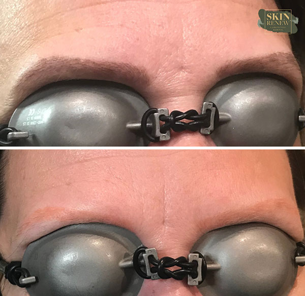 A result from Skin Renew Day Spa & Laser Center