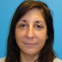 A result from PREMIERE Center for Cosmetic Surgery Tampa