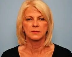A result from PREMIERE Center for Cosmetic Surgery Tampa